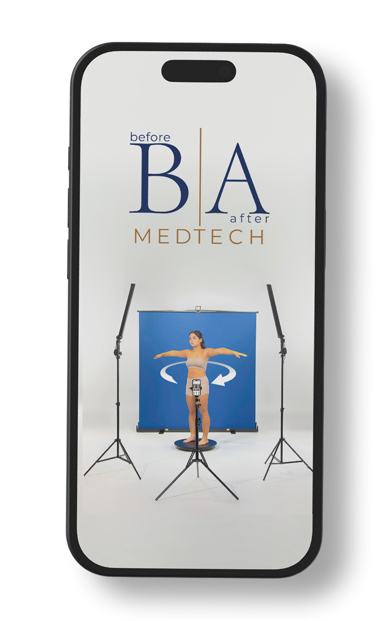 Patient before BBL, donor areas in green and receptor areas in red