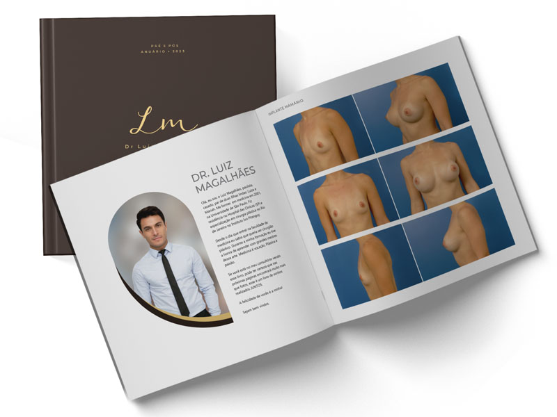 Patient before BBL, donor areas in green and receptor areas in red