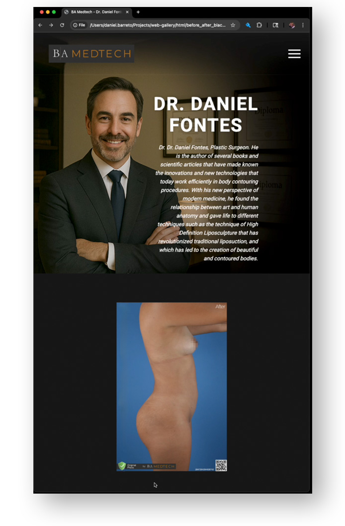 Patient before BBL, donor areas in green and receptor areas in red